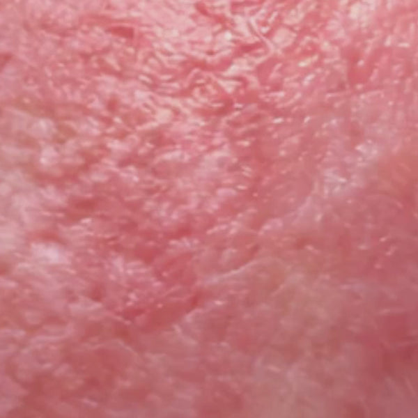 Vidéo montrant la progression d’une peau sensible dont les rougeurs s’atténuent après application régulière du Red Berry Serum certifié COSMOS NATURAL 30 ml – KALYAË ORIGIN