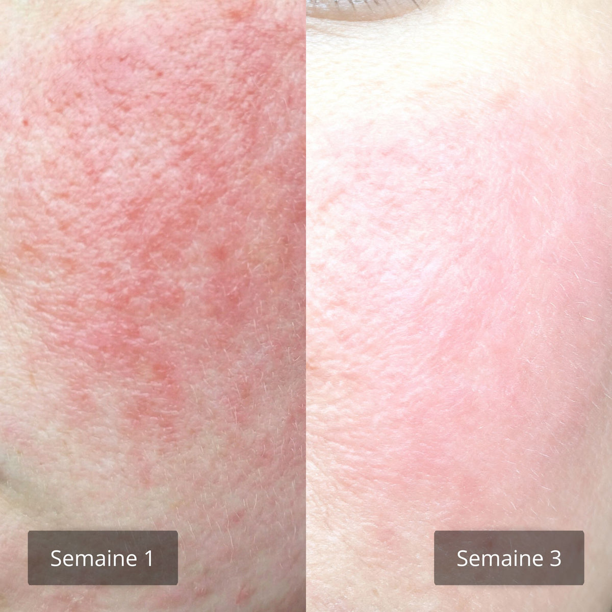 Comparatif avant après sur joue sensible entre la semaine 1 et la semaine 3 avec atténuation des rougeurs après application régulière du Red Berry Serum sérum apaisant pour peaux sensibles certifié COSMOS NATURAL – KALYAË ORIGIN