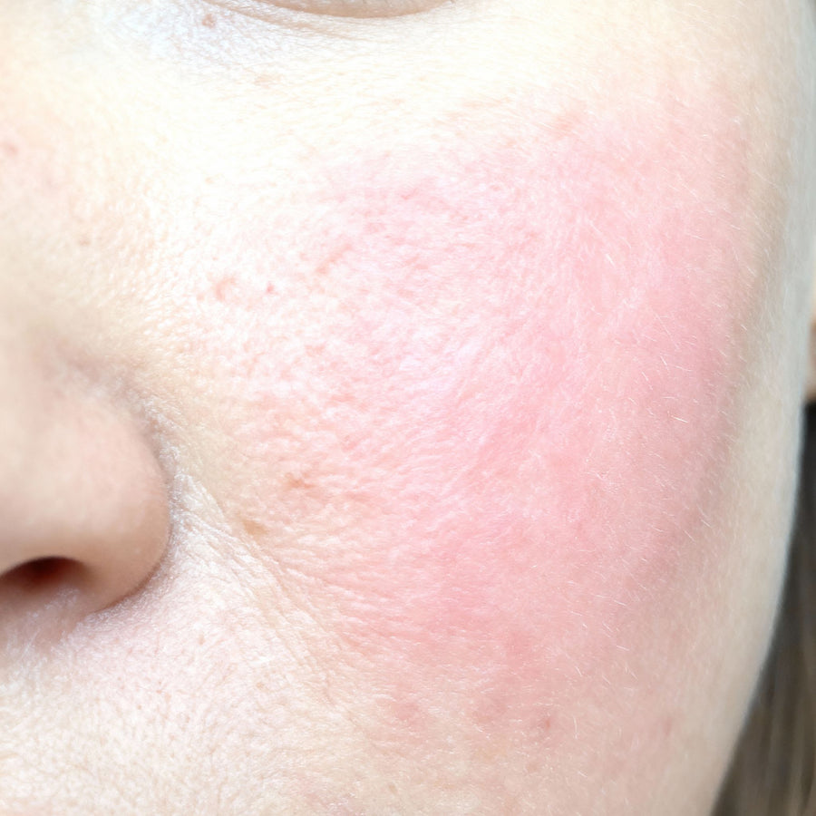 Joue de peau sensible avec rougeurs visiblement apaisées après plusieurs jours d’application du Red Berry Serum sérum apaisant pour peaux sensibles certifié COSMOS NATURAL 30 ml – KALYAË ORIGIN